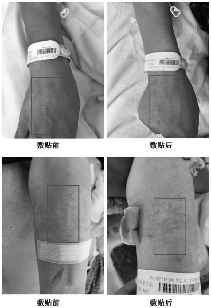 一種治療靜脈炎的中藥復(fù)方及其制備方法與應(yīng)用